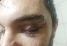 Polícia Civil confirma em laudo espancamento do cozinheiro homossexual de Balneário Piçarras