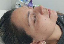 Afinal, acupuntura dói ou não?