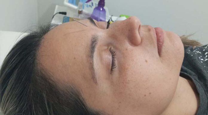 Afinal, acupuntura dói ou não?