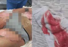 Briga de casal de mulheres deixa uma delas com 50% do corpo queimado em Itapema