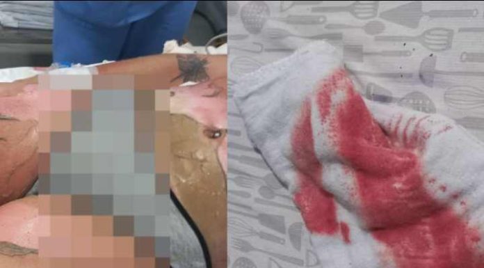 Briga de casal de mulheres deixa uma delas com 50% do corpo queimado em Itapema