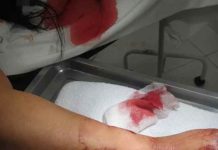 Jovem leva diversas facadas do marido durante churrasco em Bombinhas