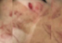 Jovem transexual é atacada em Itapema e tem garfo cravado no peito