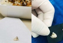 Servidora da Saúde mastiga comida da marmita e encontra dente de bicho não identificado