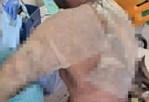 Trabalhador da Celesc sofre queimaduras em rede de alta tensão