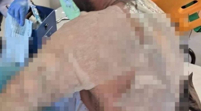 Trabalhador da Celesc sofre queimaduras em rede de alta tensão