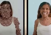Mulher enfrenta 60 horas de cirurgia para remover tumores de todo seu corpo