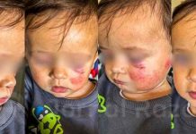 Menino é atacado a mordidas por bebê em creche de Criciúma