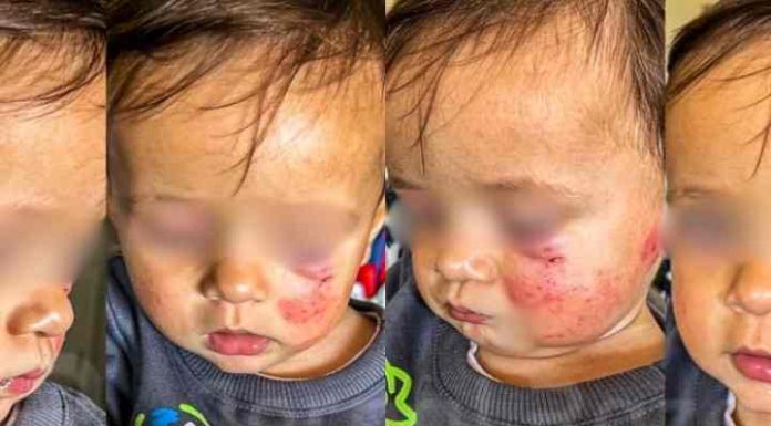 Menino é atacado a mordidas por bebê em creche de Criciúma