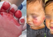 Bebê sofre queimaduras de 2º grau na mesma creche que outra criança foi machucada por mordidas