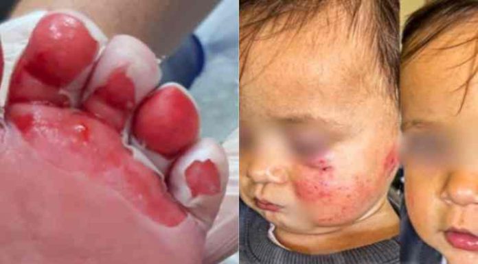 Bebê sofre queimaduras de 2º grau na mesma creche que outra criança foi machucada por mordidas