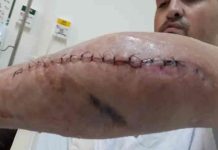 Morador amputado em acidente de moto pede auxílio para compra de prótese e pé articulado