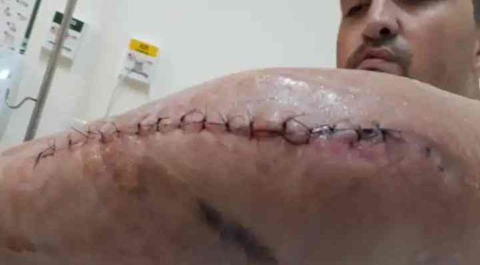 Morador amputado em acidente de moto pede auxílio para compra de prótese e pé articulado