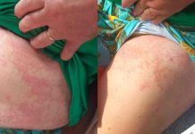 Rua do Itacolomi, em Piçarras, onde “a comunidade inteira já pegou dengue”