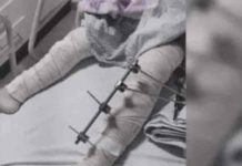 Médicos operam “perna errada” de criança de 6 anos