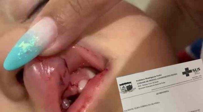 Criança de 3 anos cai, corta a boca e perde um dente em creche de Penha