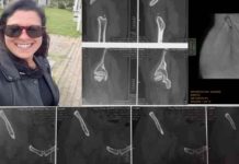 Moradora de Itapema lança vaquinha virtual para cirurgia de prótese no quadril