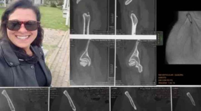Moradora de Itapema lança vaquinha virtual para cirurgia de prótese no quadril