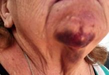 Idosa de 62 anos é espancada pelo vizinho por causa de lixo