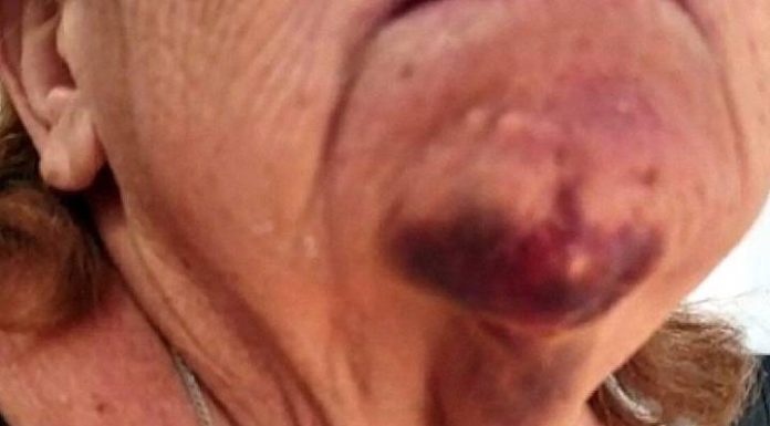 Idosa de 62 anos é espancada pelo vizinho por causa de lixo