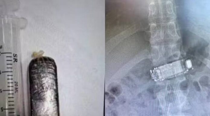 Celular fica atravessado em sistema digestório após detento engolir aparelho em SC
