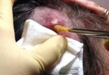 Criança é atendida com piolho e larvas que estavam comendo sua cabeça