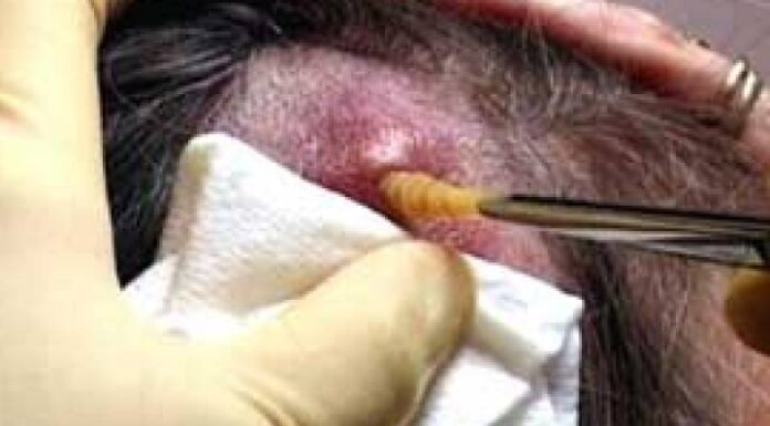 Criança é atendida com piolho e larvas que estavam comendo sua cabeça