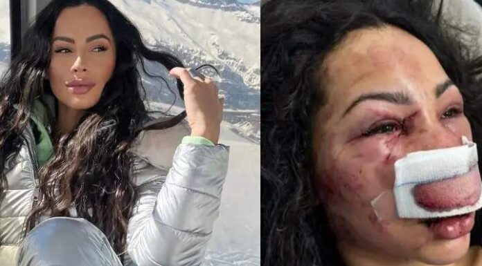 Brasileira é cruelmente espancada em assalto no Chile