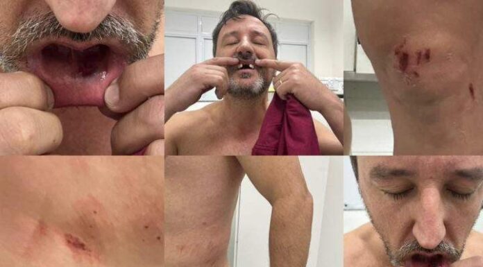 Marido de pré-candidata a prefeita do PL de Bombinhas é brutalmente agredido em festa