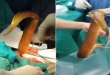 Médicos retiram enguia viva de 60 cm que entrou pelo ânus do paciente
