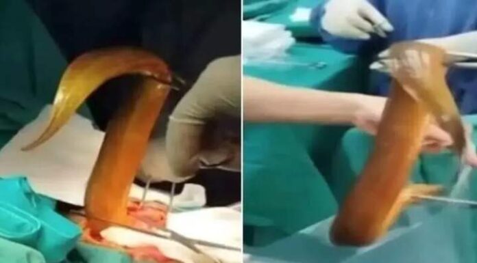 Médicos retiram enguia viva de 60 cm que entrou pelo ânus do paciente