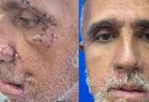 Catador sobrevive a ataque feroz de pitbulls e tem rosto desfigurado e faz cirurgia delicada