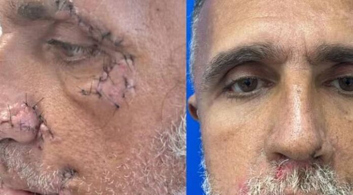 Catador sobrevive a ataque feroz de pitbulls e tem rosto desfigurado e faz cirurgia delicada