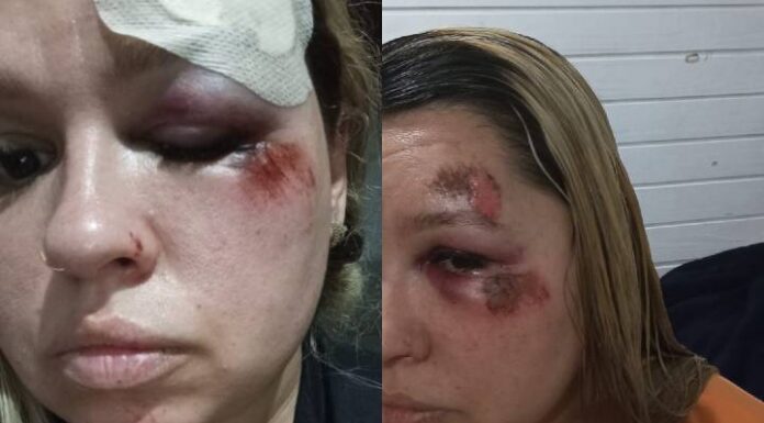 Fio solto enrosca no pneu traseiro e causa violenta queda de ciclista em Piçarras