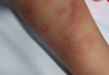 Crianças são picadas por aranha marrom em creche de Navegantes e o caso acaba no MPSC