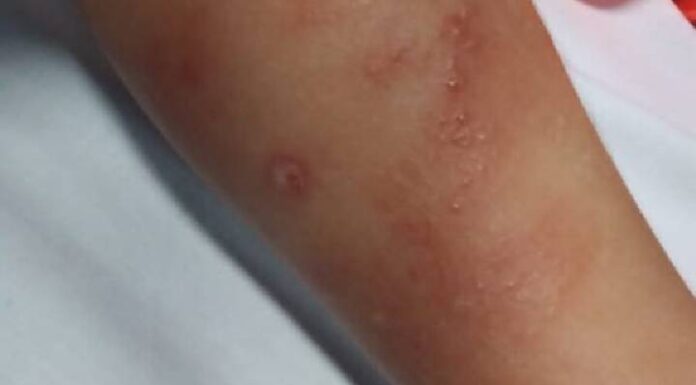 Crianças são picadas por aranha marrom em creche de Navegantes e o caso acaba no MPSC