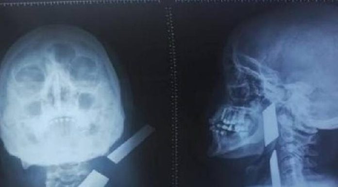 MACABRO Pai deixa faca cravada no pescoço da própria filha de 3 anos