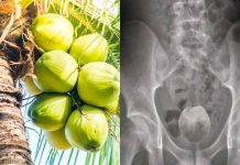 Homem enfia coco verde no ânus e passa por cirurgia