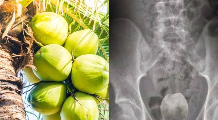Homem enfia coco verde no ânus e passa por cirurgia
