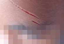 Criança é cortada com estilete dentro da escola em Piçarras