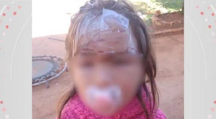 Criança de 3 anos leva 27 pontos no rosto após ser atacada pór cachorro