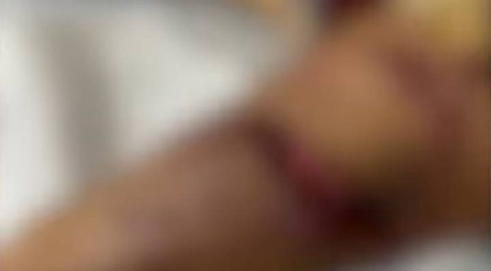 Mulher quase tem braço arrancado por pitbull em Barra Velha