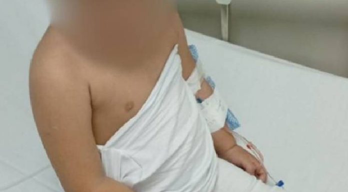 Menina tem a mão queimada pela madrasta no bairro Cordeiros