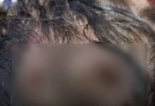 Menina de 11 anos é hospitalizada com infestação de larvas no couro cabeludo