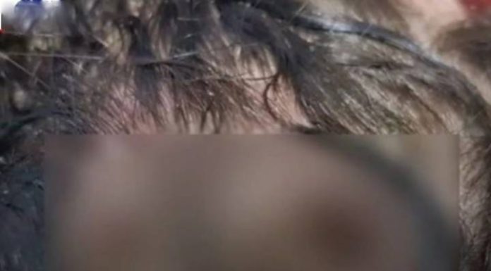 Menina de 11 anos é hospitalizada com infestação de larvas no couro cabeludo