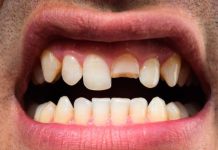 Mãe quebra dente do namorado que gravou enteada de 7 anos de calcinha