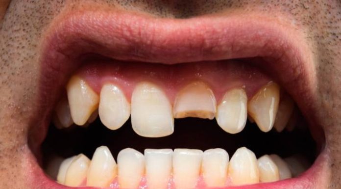 Mãe quebra dente do namorado que gravou enteada de 7 anos de calcinha