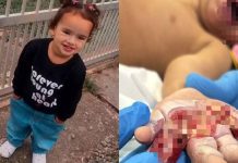 Menina de 2 anos sofre choque elétrico e perde movimentos da mão em Piçarras