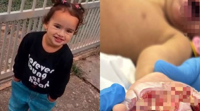 Menina de 2 anos sofre choque elétrico e perde movimentos da mão em Piçarras