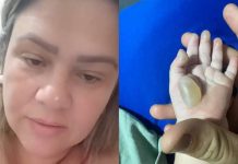 Revolta de pais: criança de 1 ano tem queimaduras de 2º grau dentro de creche em SC